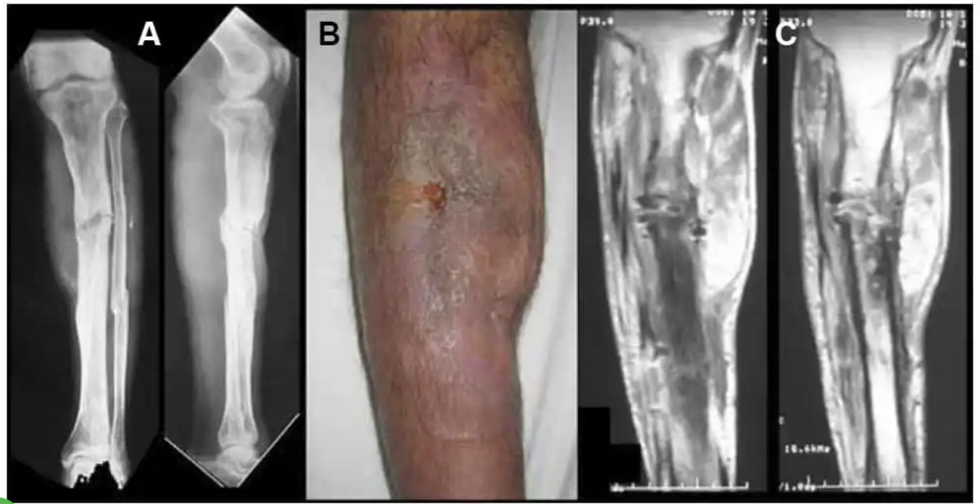 Osteomielite Tem Cura?